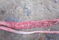 腸毒綜合癥該怎么判斷治療（保存收藏）